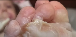 Criança sofre queimadura de 3º grau ao pisar em tampa de ferro aquecida pelo calor extremo